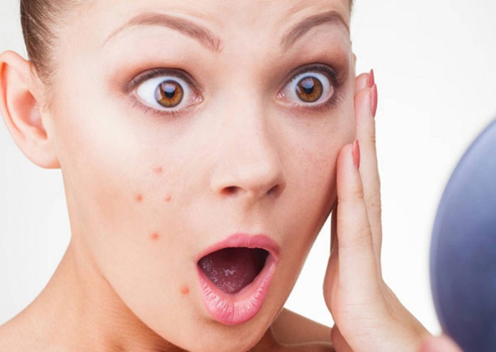 Get Rid of Pimples पिंपल्स के लिए टूथपेस्ट है 'रामबाण' इलाज, लेकिन गलत इस्तेमाल से हो सकती है गंभीर समस्या