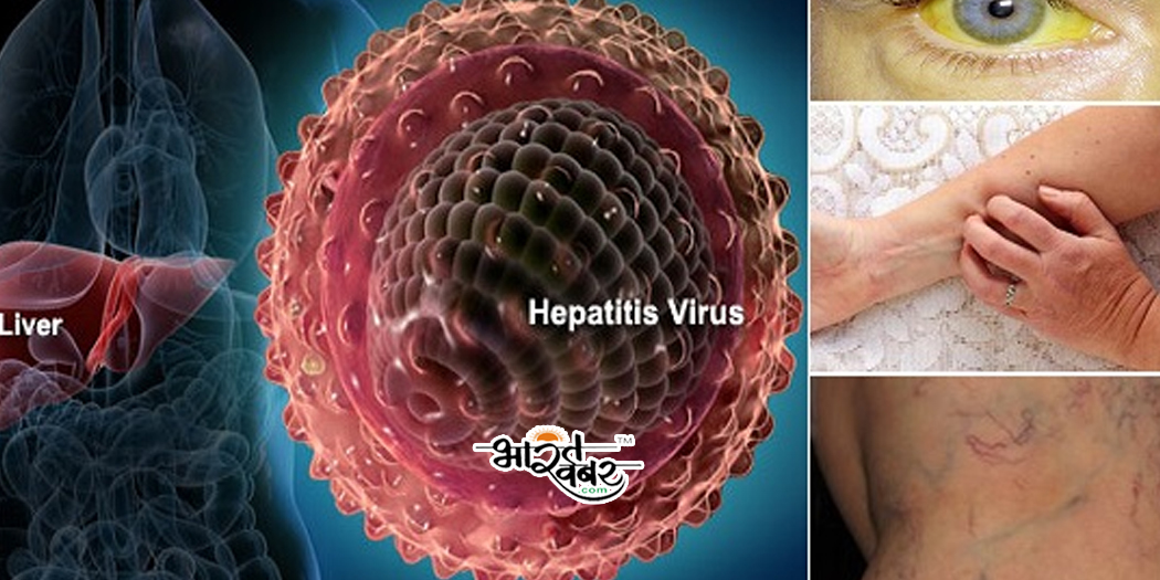 Hepatitis disease जागरूकता के अभाव में महामारी का रूप ले रहा है हेपेटाइटिस