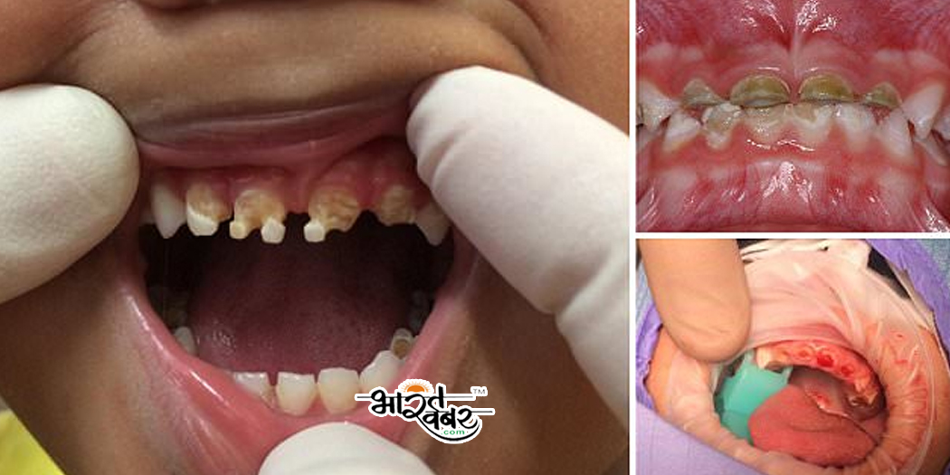 teeth operation डॉक्टरों ने बच्चे के जबड़े से निकाला 526 दांत, पांच घंटे चली सर्जरी
